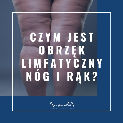 Czym jest obrzęk limfatyczny nóg i rąk?