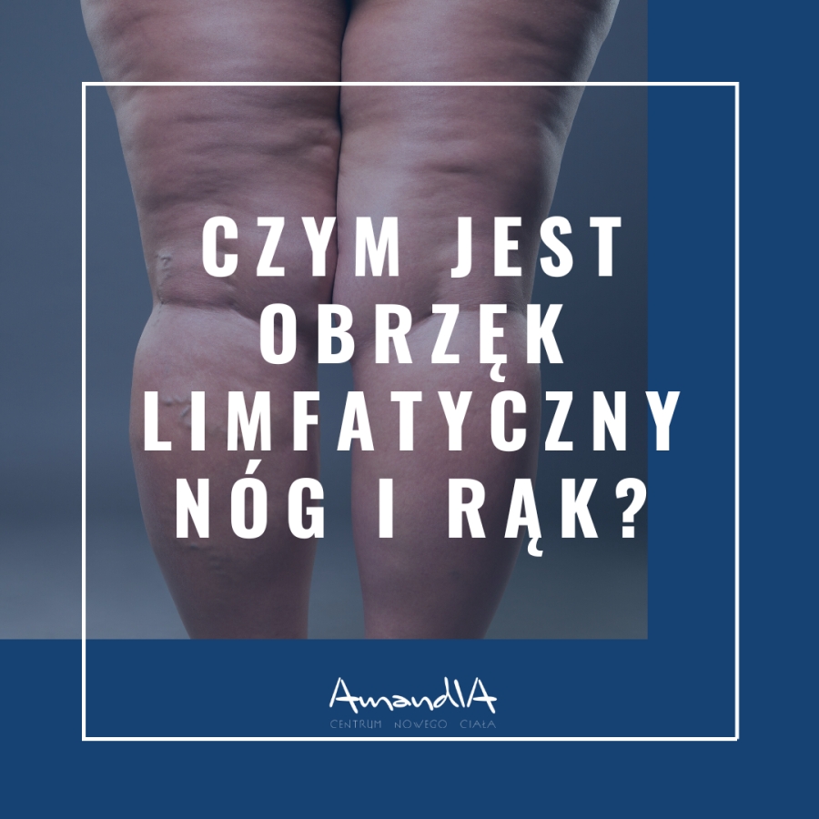 Czym jest obrzęk limfatyczny nóg i rąk?